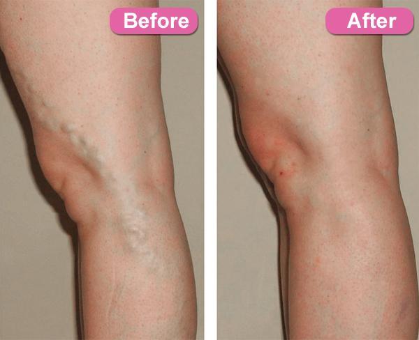 Varicose Veins Treatment Cream