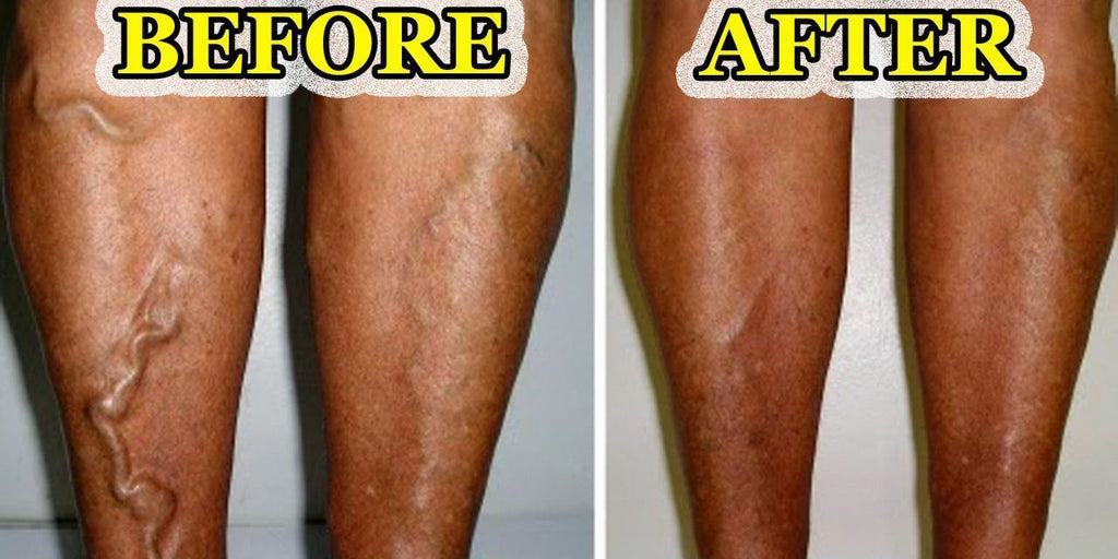 Varicose Veins Treatment Cream