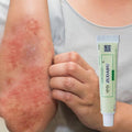 Herbal Eczema Cream