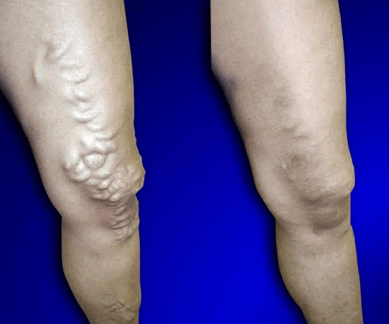 Varicose Veins Treatment Cream