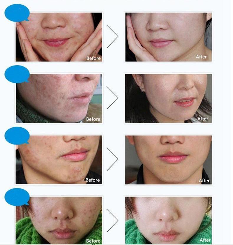 Body Acne Treatment Cream