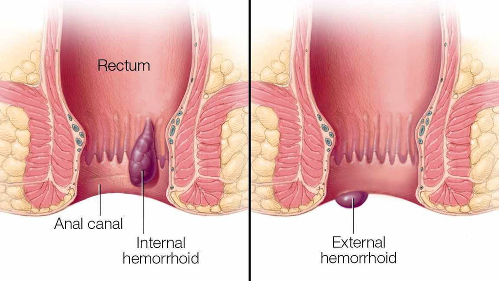 Chinese Herbal Hemorrhoids Cream