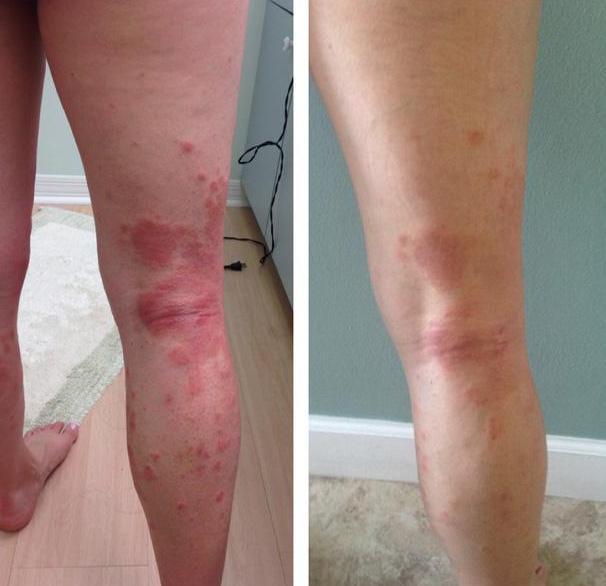 Herbal Eczema Cream